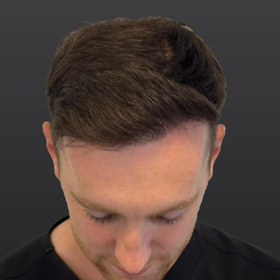 Dr Prosser ten months after his own hair transplant