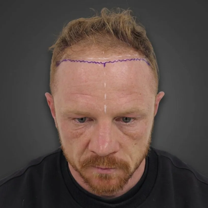 Luke Jackson on the day of surgery, hairline mapped, front view