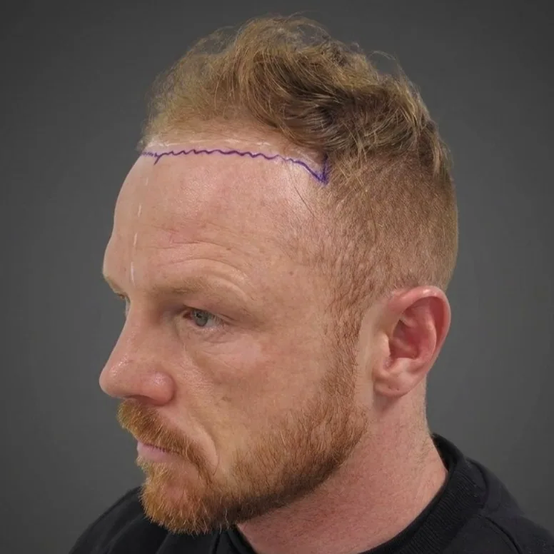 Luke Jackson on the day of surgery, hairline mapped, side view
