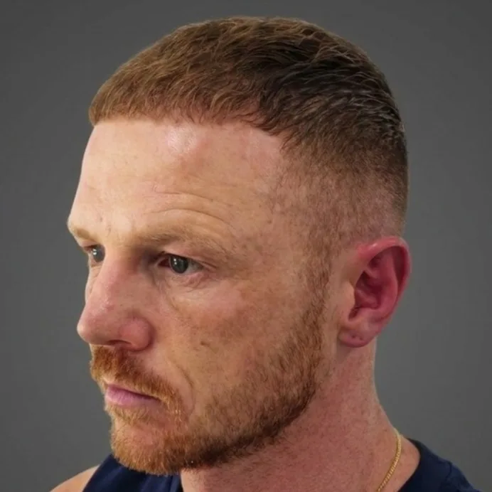 Luke Jackson six months after his hair transplant, side view
